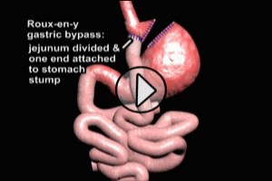 Roux-En-Y Bariatric Surgery