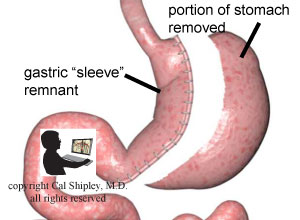 Sleeve Gastrectomy Bariatric Procedure