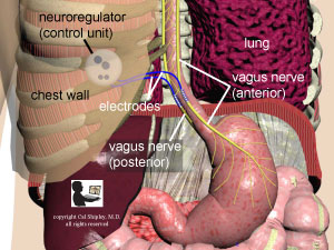 Vagus Blockade Bariatric Procedure