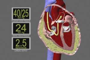 Swan-Ganz Pulmonary Catheter