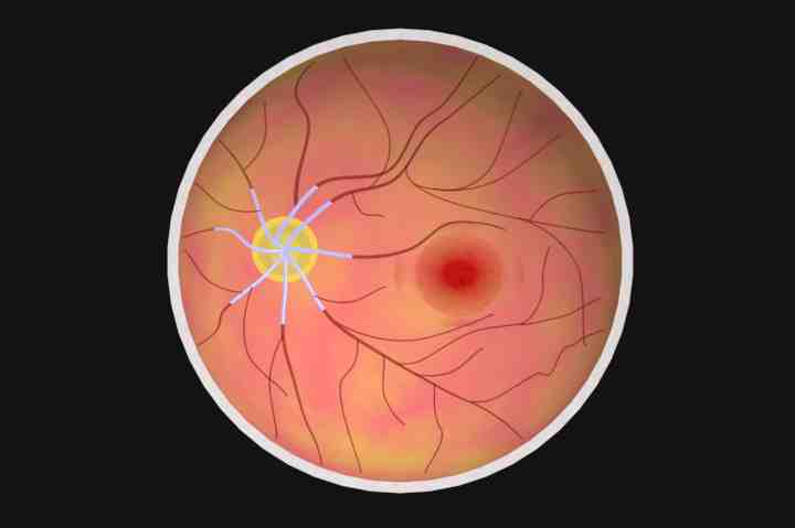 ophthalmic artery embolism