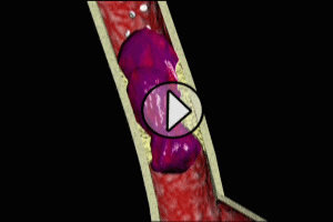 coronary thrombosis and myocardial infarction video