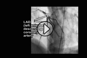 Coronary Angiogram