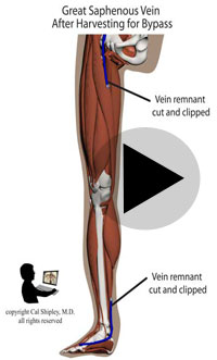 great saphenous vein after harvesting