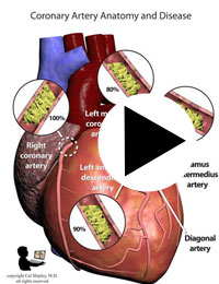 coronary disease anterior