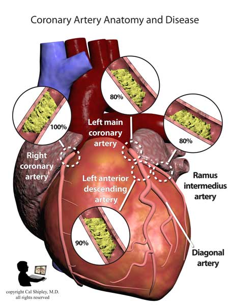 Coronary Artery Anatomy and Disease Anterior