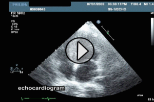 Echocardiogram