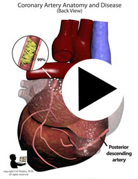 coronary artery disease posterior