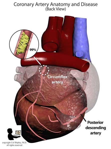 coronary arteries and disease posterior