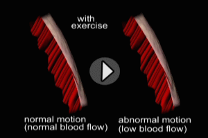 Ventricular Wall Motion