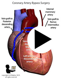 Myocardial Infarction Coronary Artery Bypass Graft (CABG)