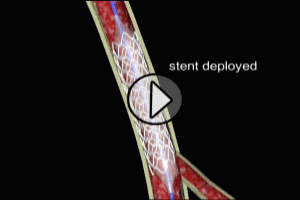 myocardial infarction coronary angioplasty