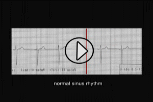 myocardial infarction cardiac arrhythmias