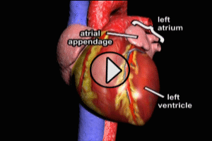 Atrial Fibrillation and Stroke