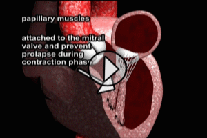 Mitral Valve Rupture