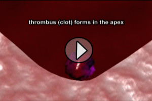 Myocardial Infarction Mural Ventricular Thrombus