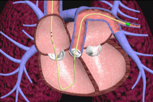 pulmonary artery swan ganz catheter