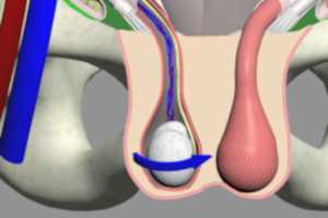 testicular torsion
