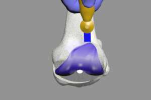 Revision of Knee Replacement Surgery
