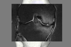 torn meniscus degnerative arthritis