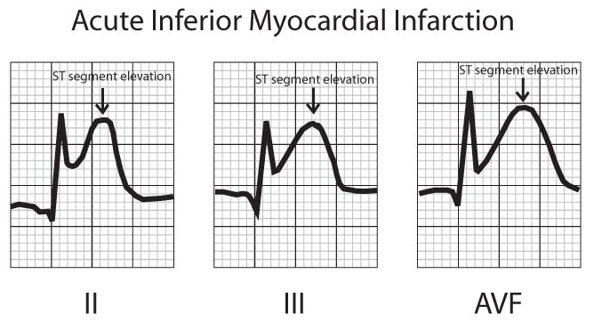 Myocardial Infarction elevated ST segments