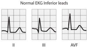 Ekg Acute Myocardial Infarction Patterns Brilliant | SexiezPix Web Porn