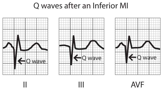 Myocardial Infarction Q waves