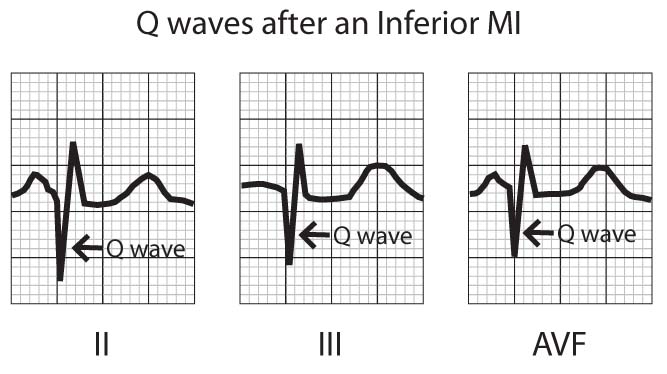 no q wave on ekg