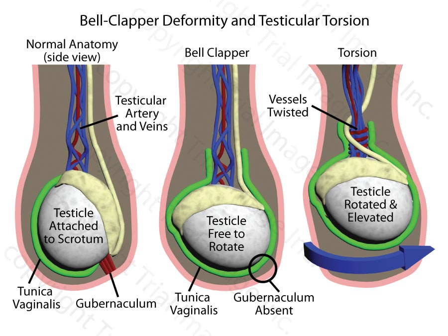 Bell Clapper Deformity