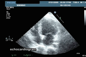 Echocardiogram