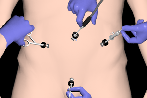 laparoscopic pelvic surgery