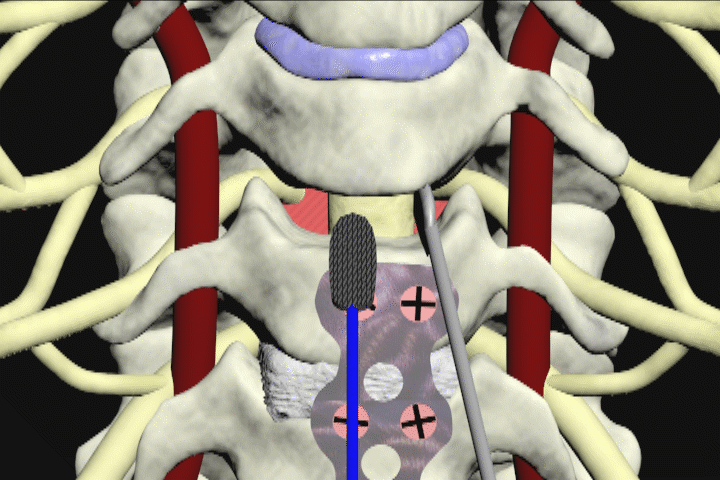 cervical discectomy synthes implant