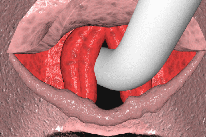 endotracheal intubation complications