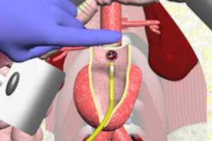 Aortoiliac Graft for Abdominal Aortic Aneurysm