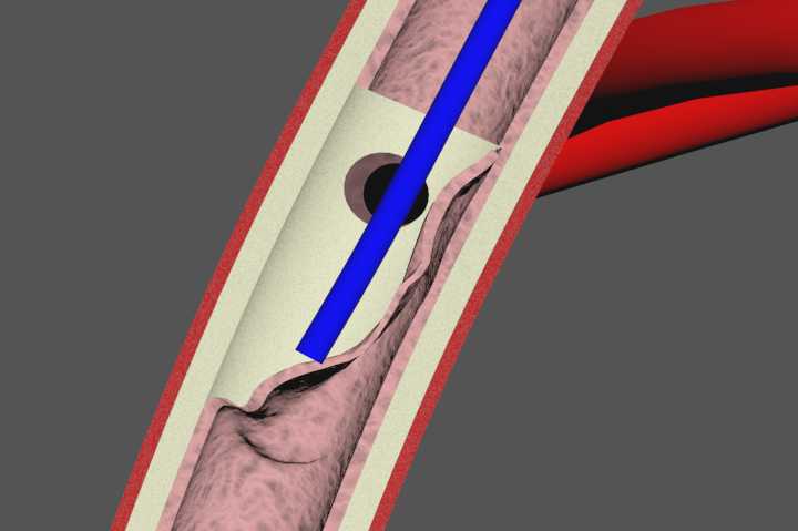 Popliteal Artery Intimal Tear