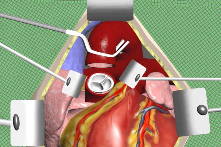 aortic valve replacement