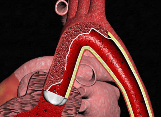 Aortic Dissection and Cardiac Tamponade