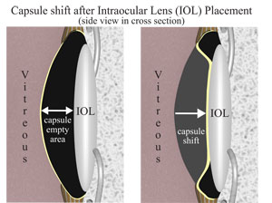 Intraocular Lens