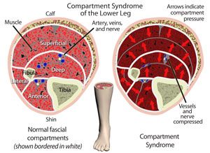 Compartment Syndrome Lower Limb