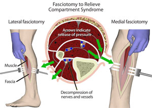 fasciotomy lower limb