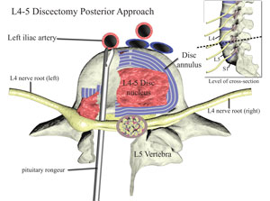 lumbar discectomy