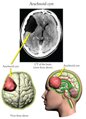 Arachnoid Cyst