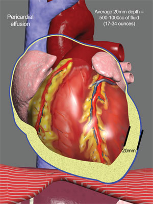 pericardial effusion