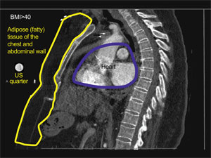 CT scan sagittal adipose tissue