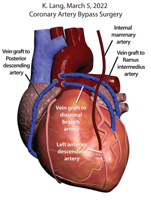 Coronary Artery Bypass