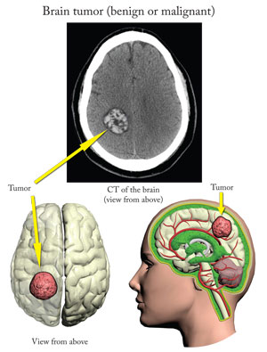 Cerebral-Tumor