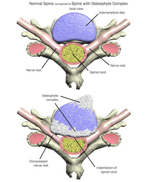 cervical spine osteophytes