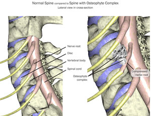 Cervical Spine Osteophytes Lateral