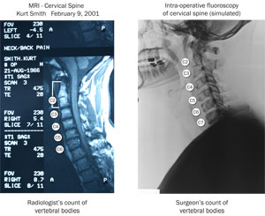 Cervical-Spine-Imaging-Xray-lateral