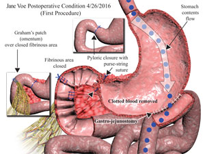 Gastrojejunostomy